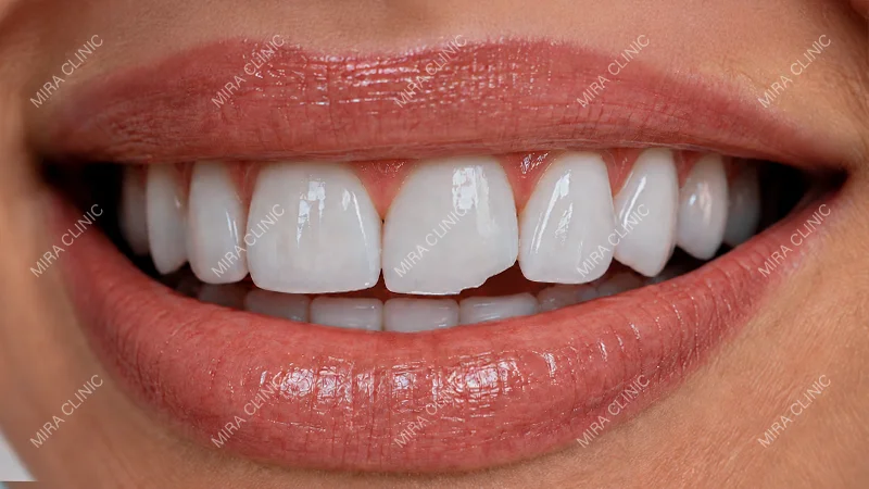 Chipped or Broken Veneers